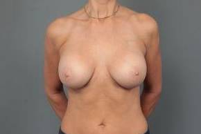 after breast augmentation front view case 2714