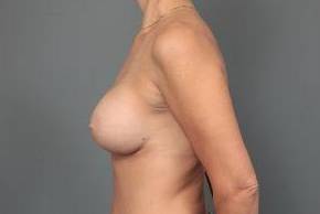 after breast augmentation left side view case 2714