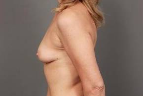 before breast augmentation left side view case 2714