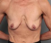 before breast augmentation front view case 2721