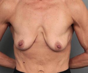 before breast augmentation front view case 2721