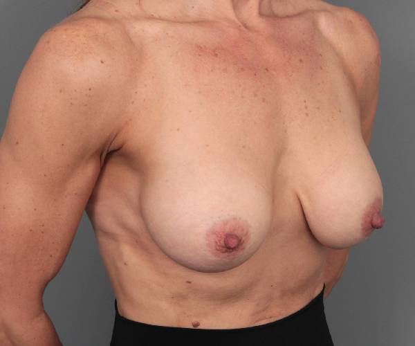 after breast augmentation right angled view case 2721