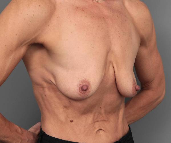 before breast augmentation right angled view case 2721