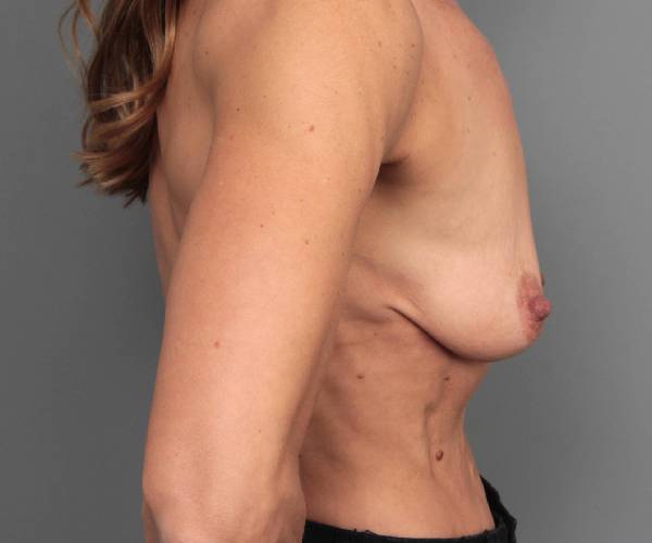 before breast augmentation right side view case 2721