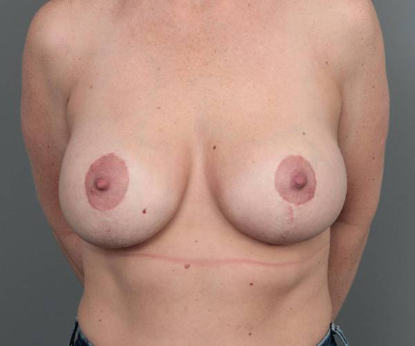 after breast augmentation front view case 2734