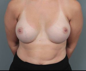 after breast augmentation front view case 2742