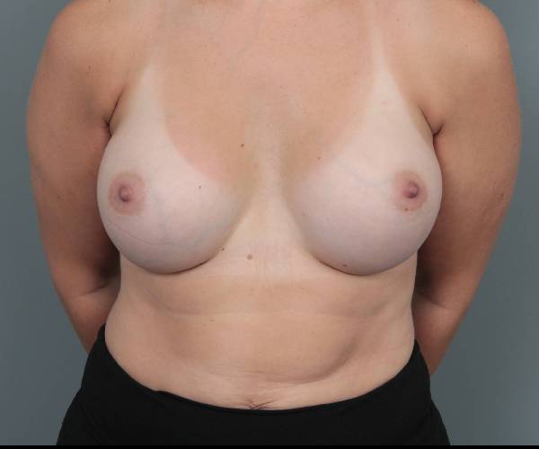 after breast augmentation front view case 2742