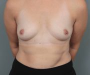 before breast augmentation front view case 2742