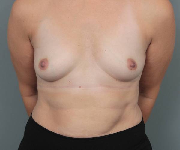 before breast augmentation front view case 2742