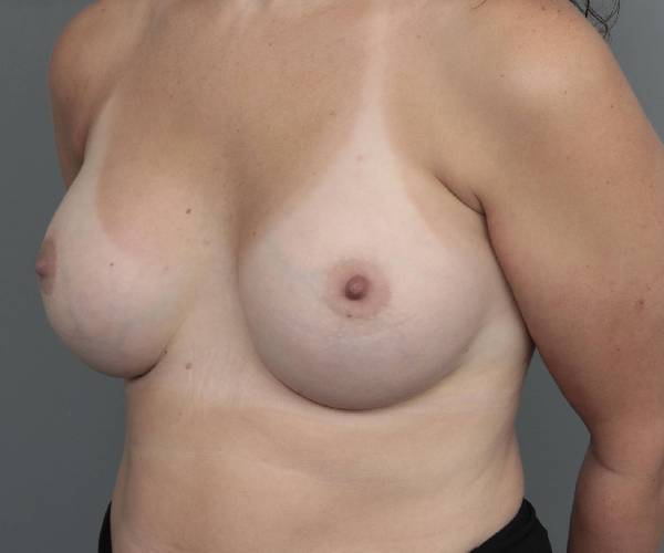 after breast augmentation left angled view case 2742
