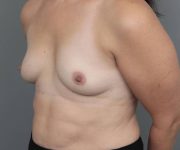 before breast augmentation left angled view case 2742