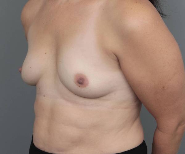 before breast augmentation left angled view case 2742