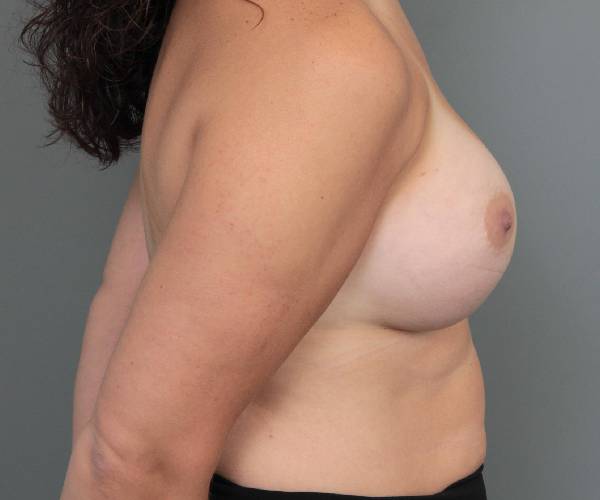 after breast augmentation right side view case 2742