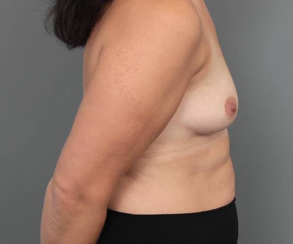 before breast augmentation right side view case 2742