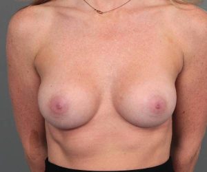 after breast augmentation front view case 2749