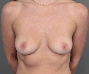 before breast augmentation front view case 2749