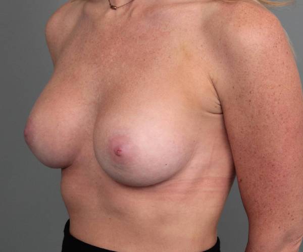 after breast augmentation left angled view case 2749