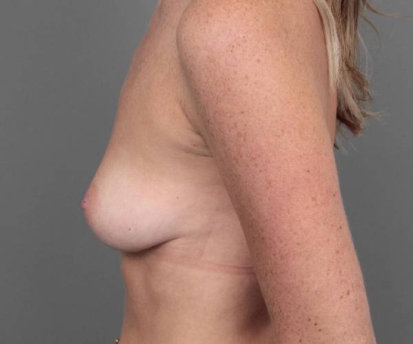 before breast augmentation left side view case 2749