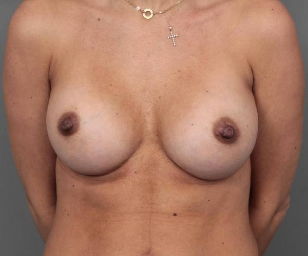 after breast augmentation front view case 2756