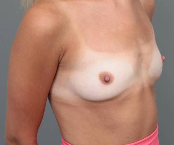 before breast augmentation right angled view case 2775