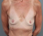 before breast augmentation front view case 2782