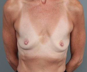 before breast augmentation front view case 2782