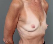 before breast augmentation right angled view case 2782