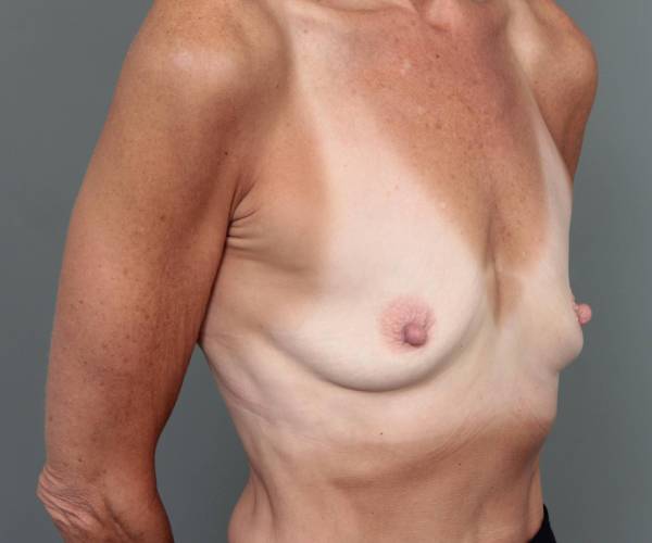 before breast augmentation right angled view case 2782