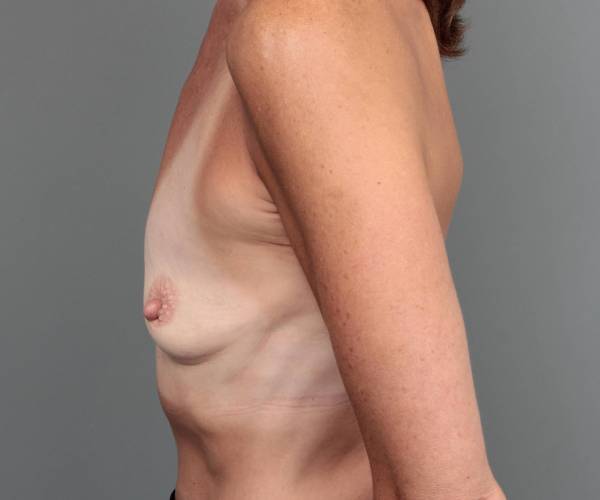 before breast augmentation left side view case 2782