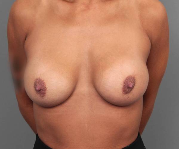 after breast augmentation front view case 2789