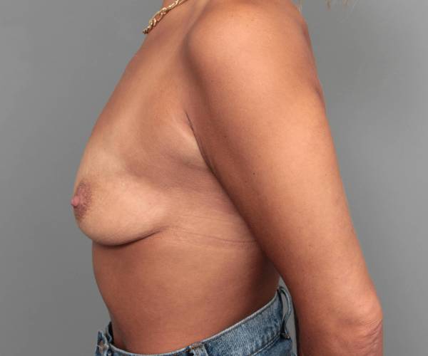 before breast augmentation left side view case 2789