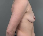 before breast augmentation right side view case 2798