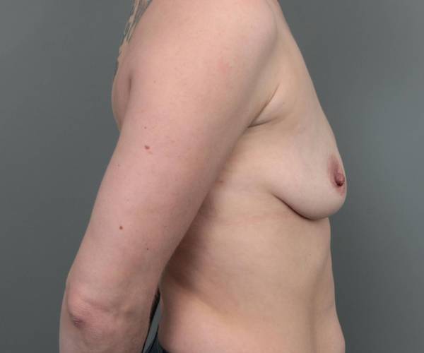before breast augmentation right side view case 2798