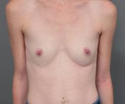 before breast augmentation front view case 2805