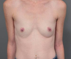 before breast augmentation front view case 2805