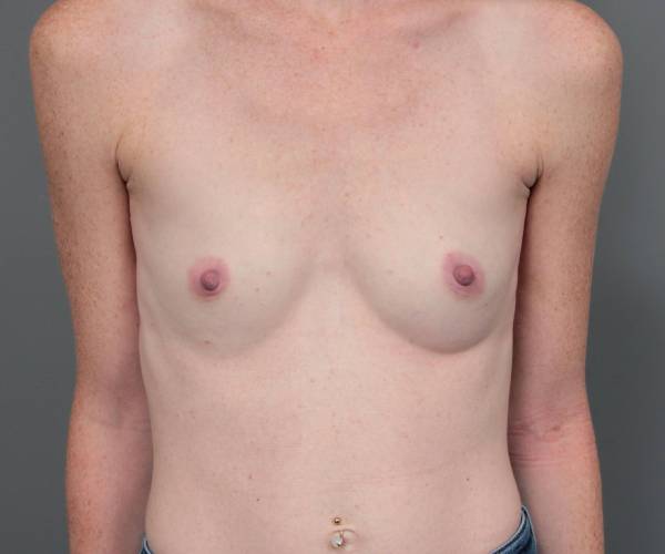 before breast augmentation front view case 2805