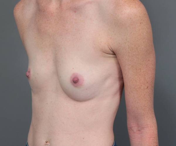 before breast augmentation left angled view case 2805
