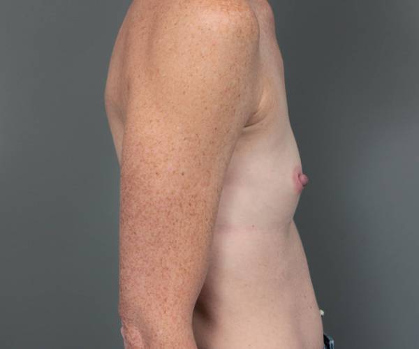 before breast augmentation right side view case 2805