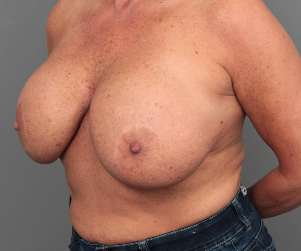 before breast implant removal with lift left angled view case 2366