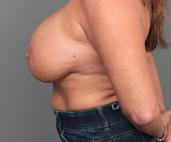 before breast implant removal with lift left side view case 2366
