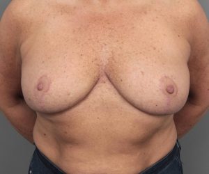 after breast implant removal with lift front view case 2366