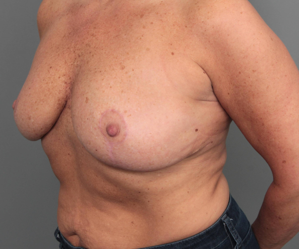after breast implant removal with lift left angled view case 2366