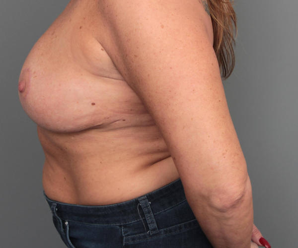 after breast implant removal with lift left side view case 2366