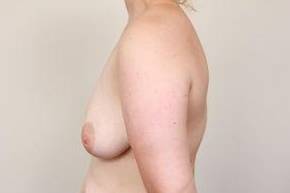 before breast lift left side view case 1831