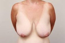 before breast lift front view case 1847