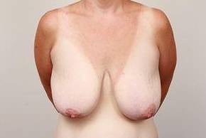 before breast lift front view case 1847