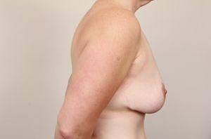 after breast lift right side view case 1847