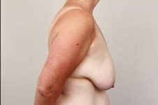 before breast lift right side view case 1847