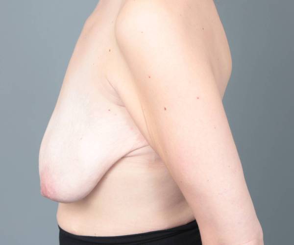 before breast lift with augmentation left side view case 3671