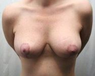 after breast lift with augmentation front view case 3683
